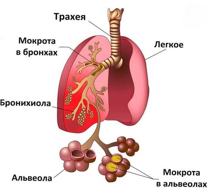 пневмония после инсульта