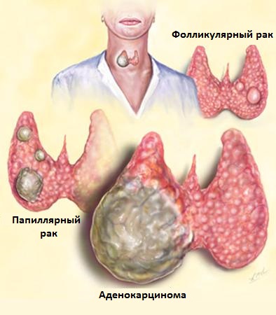 Виды рака щитовидки