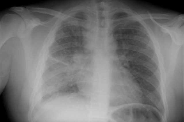 Милиарный туберкулез легких