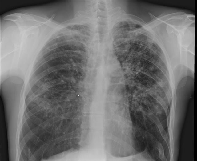 Диссеминированный туберкулёз левой и правой части лёгкого грудной клетки