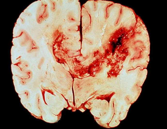 олигодендроглиома головного мозга виды