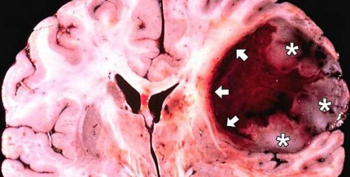 Гемангиома головного мозга: причины, симптомы, лечение