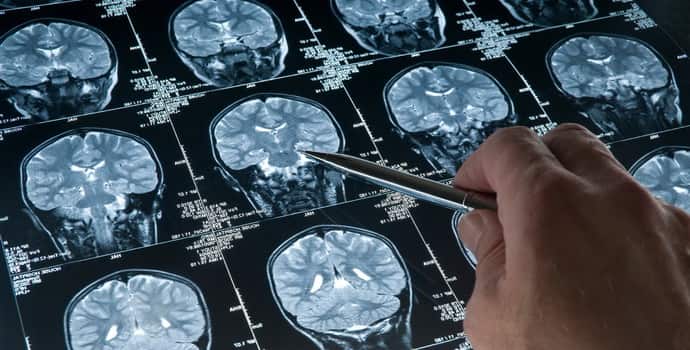 МРТ при эпилепсии: как проходит процедура