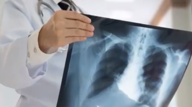 Доктор осматривает снимок легких при туберкулезе
