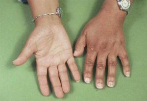 Пигментация рук