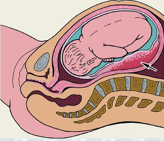 Гематома при беременности на ранних сроках причины и последствия