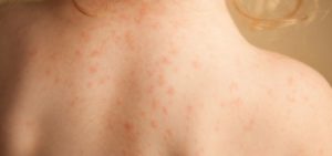 Аллергия при дисбактериозе