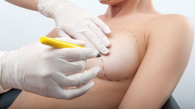 Операция по увеличению грудных желез