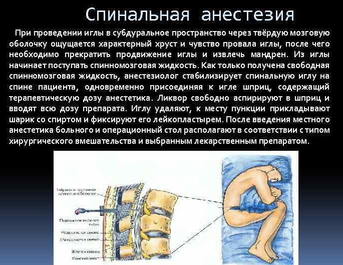 Спинальная анестезия