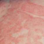 Фото аллергического дерматита на спине у взрослого