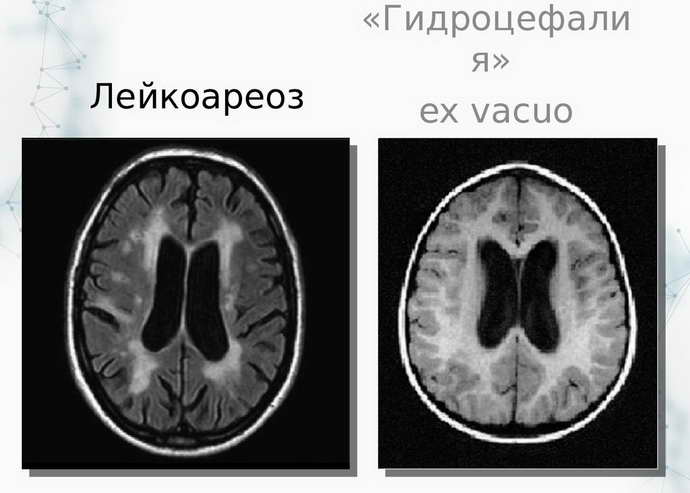 лейкоареоз головного мозга причины