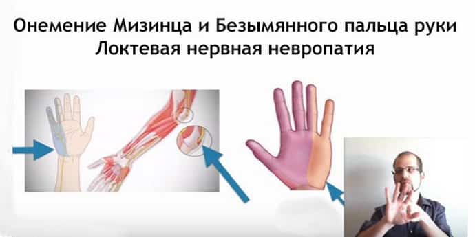 Немеет мизинец на левой руке: причины, симптомы, терапия