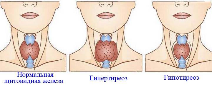 лечение щитовидки у женщин