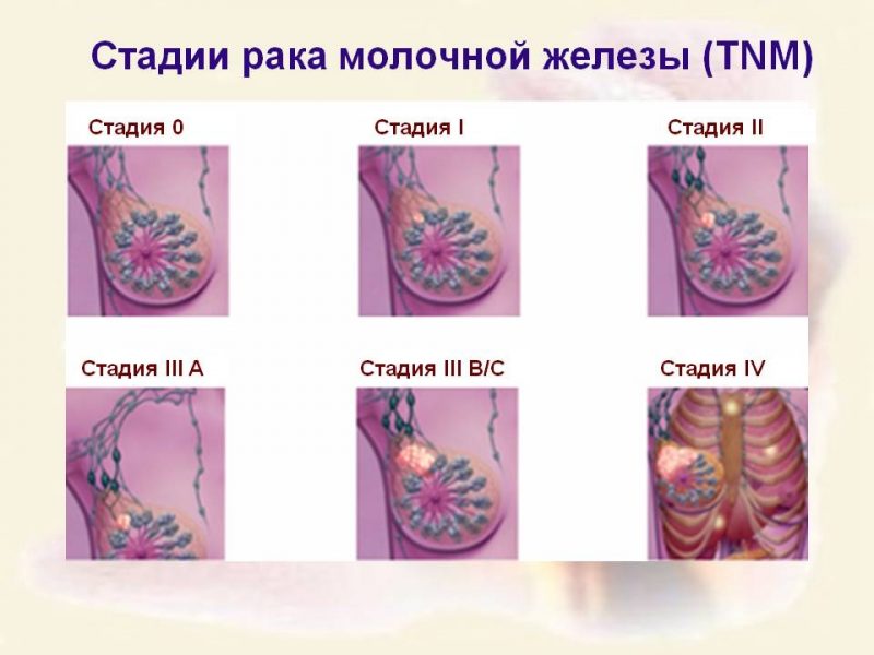 Стадии рака молочной железы