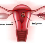прикрепление эмбриона к стенке матки