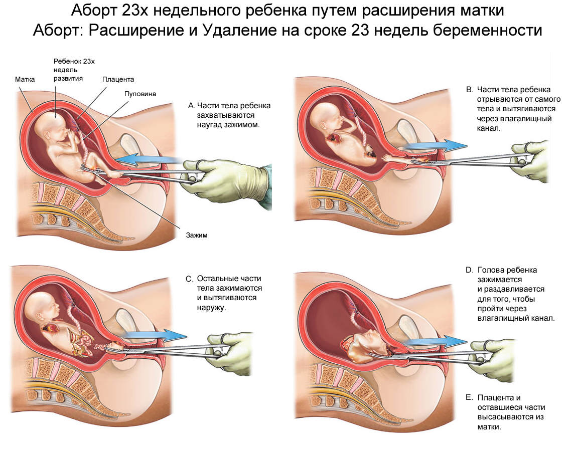 Хирургический аборт выскабливание