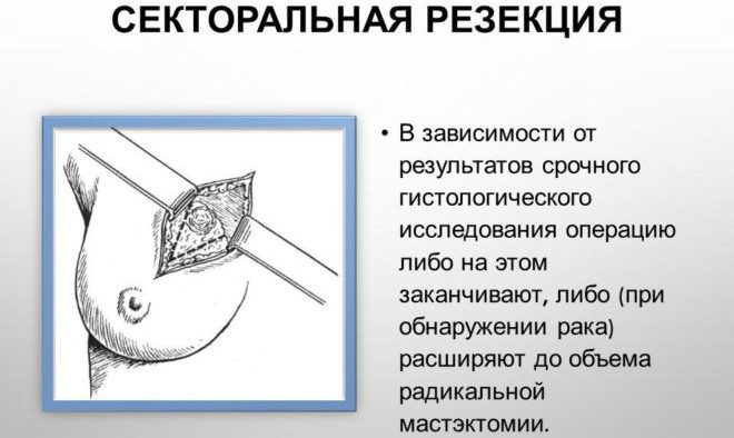 секторальная резекция фиброаденомы молочной железы