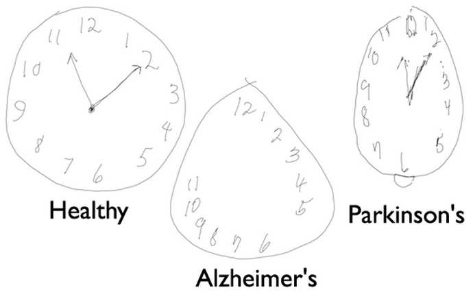 деменция альцгеймеровского типа тесты