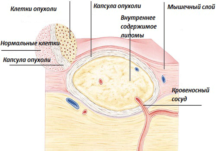 Липома молочной железы