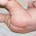 пеленочный дерматит у детей лечение фото