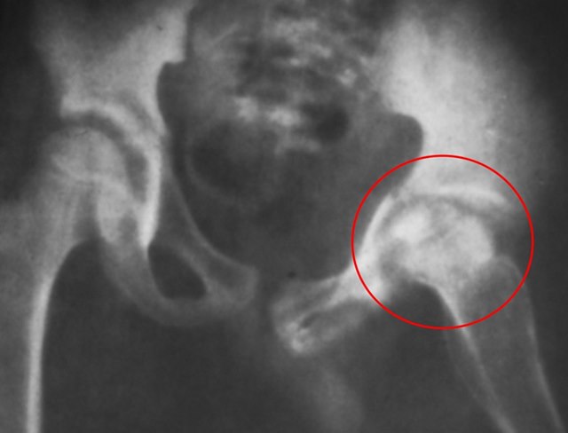 Туберкулёз тазобедренного сустава изменение формы суставной ямки и головки бедра