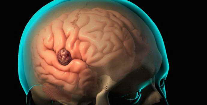 В чем опасность абсцесса мозга, и как лечить такое заболевание