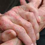 контактный аллергический дерматит фото на пальцах рук