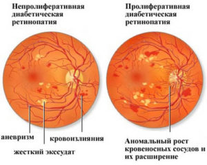 Непролиферативная ретинопатия