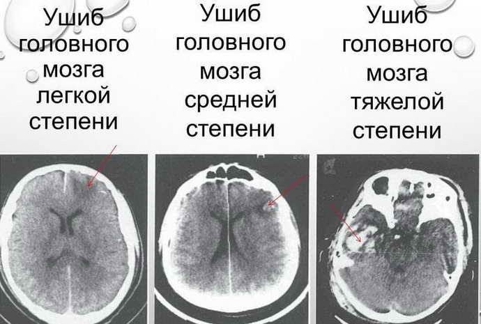ушиб мозга