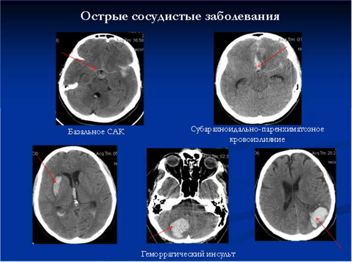 МРТ сосудистых патологий мозга