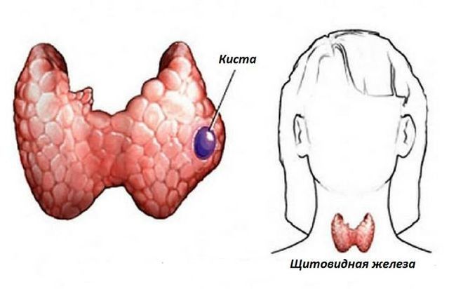 Как выглядит щитовидная железа фото