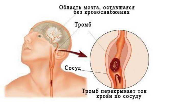 инсульт в молодом возрасте симптоматика