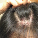 Фото дерматита на голове у взрослого