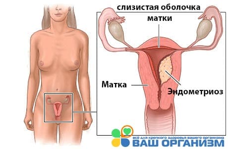эндометриоз матки