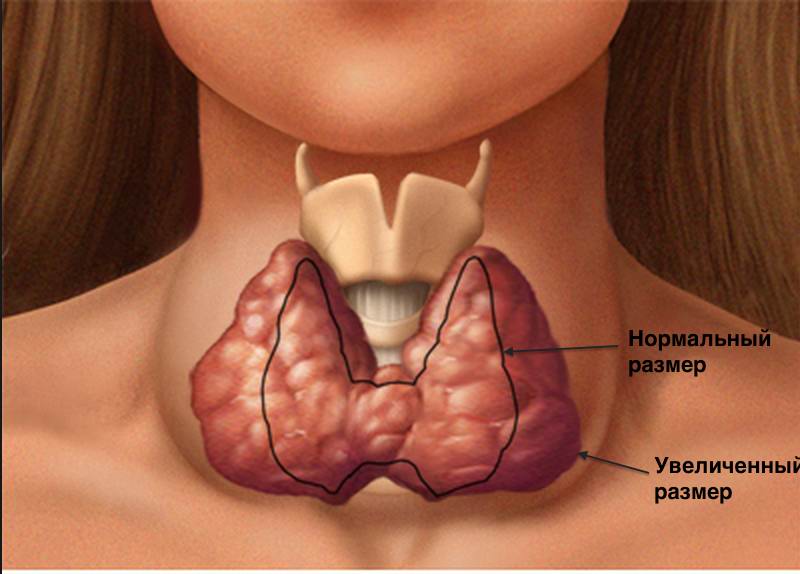 признаки повышенной функции щитовидной железы