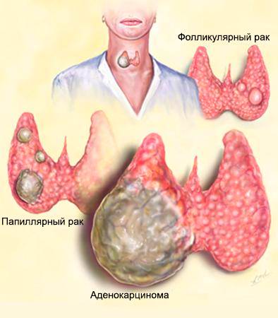 Рак щитовидки прогноз