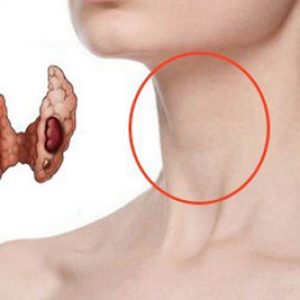  Киста на щитовидке 